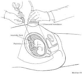 amniocentesis