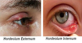 Mata Bintitan Hordeolum Eye Stye Pengertian Jenis 