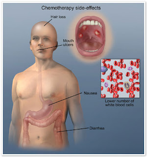 Mesothelioma Chemotherapy