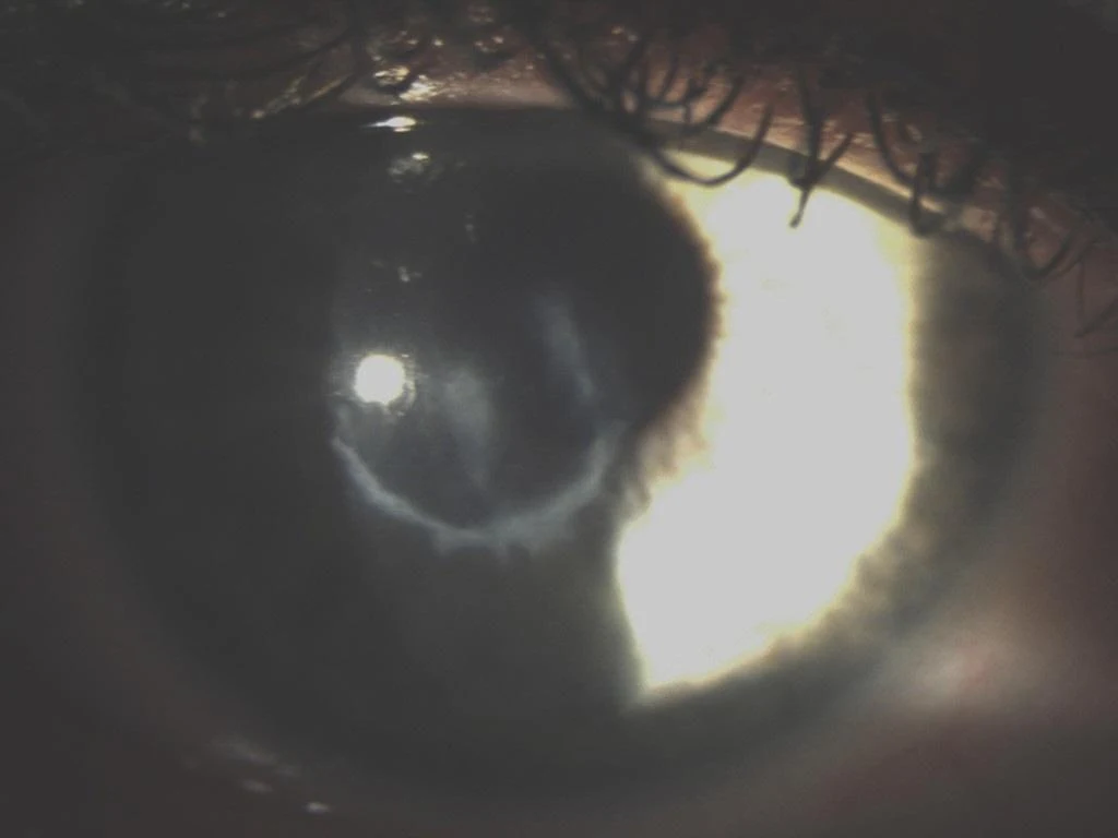 I have severe scarring on my corneas. Here is a picture of the scarring taken in 2014.  (Keratoconus Group Blog)