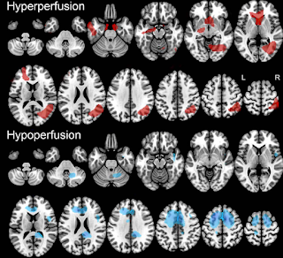 脳の過灌流と低灌流の図