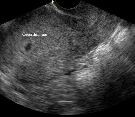 BILIK SONOGRAFER : Kehamilan Awal (Kehamilan Trimester 1)