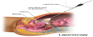 laparoscopic surgeon in indore