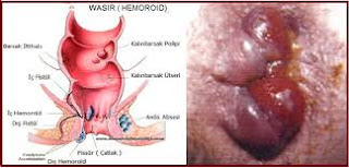 Obat Untuk Wasir Ibu Hamil