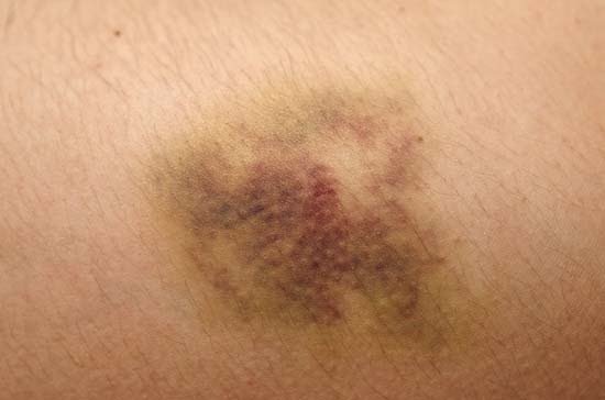 http://kids.britannica.com/comptons/art-168848/A-purple-bruise-is-fading-to-yellow-due-to-formation