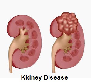 kidney disease: causes, symptoms, diagnosis and treatment