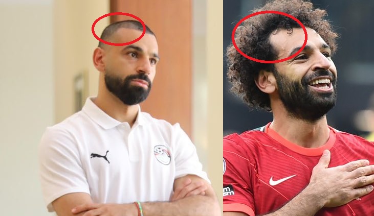 Mohamed Salah dopo il trapianto di capelli e prima