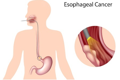 Stage 3 Esophageal Cancer treatment.