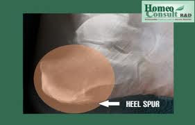 bone spur in heel