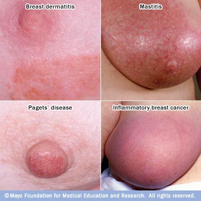 Cancer of the breast is Cancer of the breast is