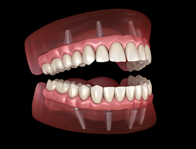 Popular Dental Treatments