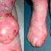 Home Remedies and Symptoms Of Epidermolysis Bullosa