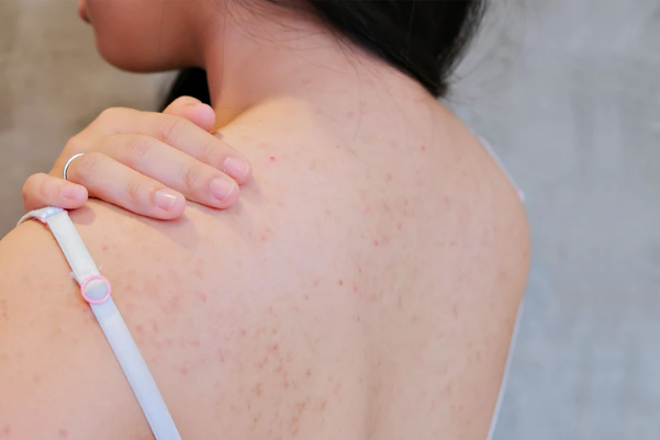 6-effective-home-remedies-for-back-acne