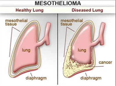 How to Get Compensation For Mesothelioma