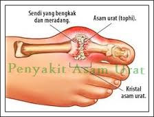 obat asam urat dan pantangannya