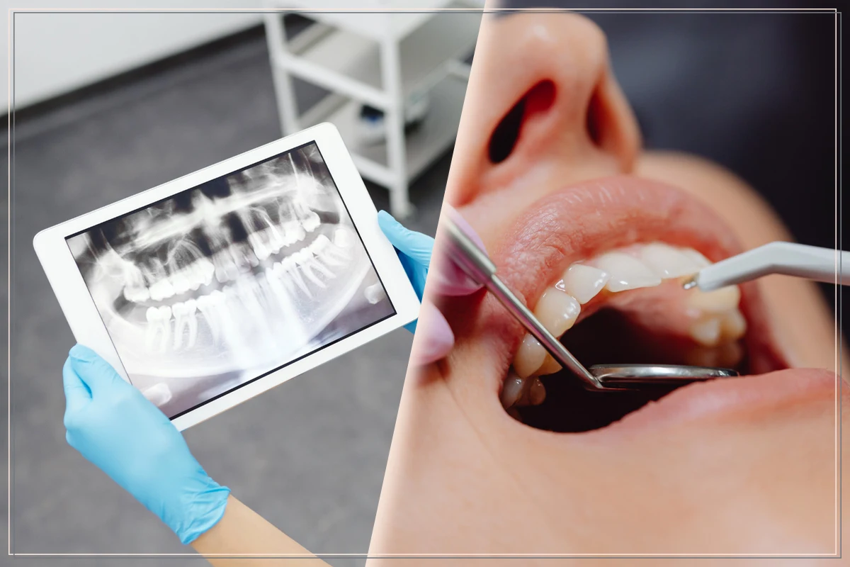 collage, two images: doctors hands holding x-ray snap of a mouth, opened mouth with braces