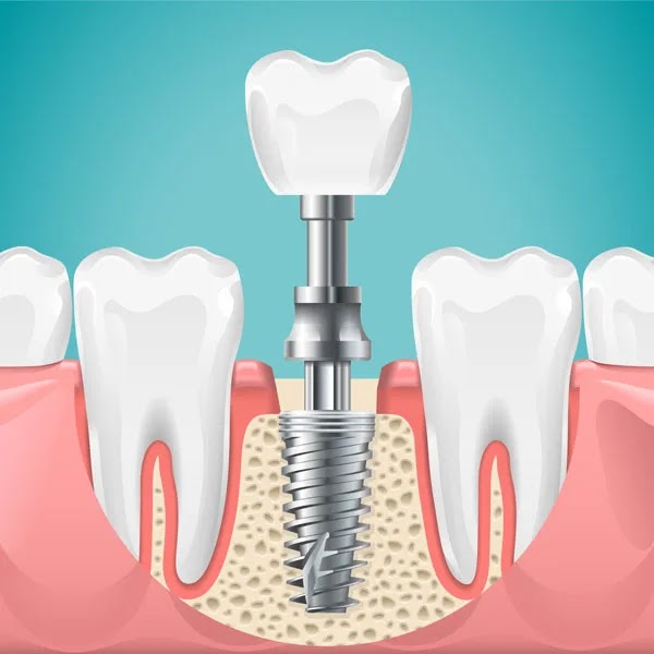 Dental Implant Fixing