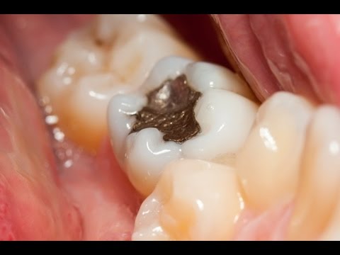 Teeth pain relief in hindi