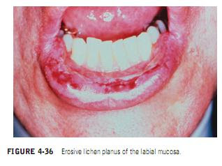 EROSIVE LICHEN PLANUS