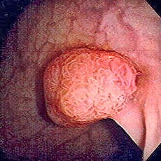 Tips mencegah pembentukan polip di usus besar