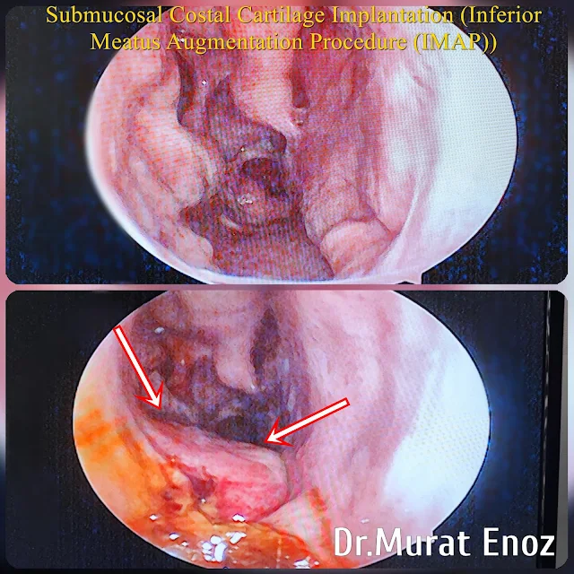 dry nose,fibrotic turbinate,Empty Nose Syndrome,Inferior Meatus Augmentation,Nasal Hyperventilation,Submucosal Costal Cartilage Implantation,cooling of turbinates,