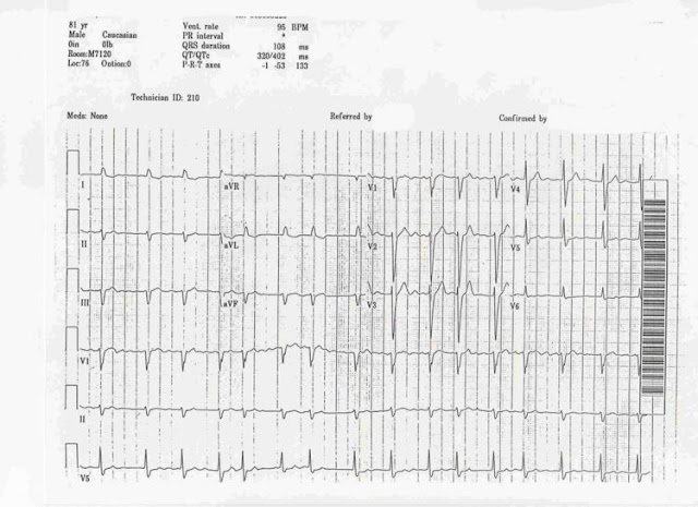 Atrial Fibrillation