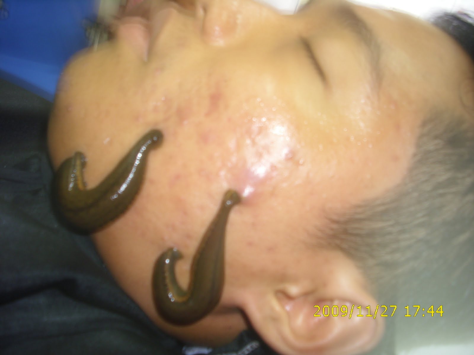 Terapi Bekam Lintah 010-508 9855 / 017 279 4353 Hana 