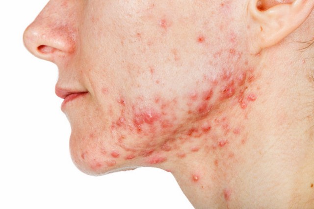 nodular-acne-treatment