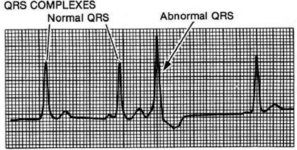 Prognosis and Treatment of Abnormal Heartbeats