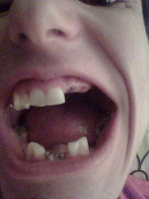 Karlene, anorexic, loss of teeth