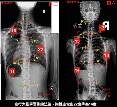 脊椎側彎矯正成功,脊椎側彎檢查, 脊椎側彎度數, 脊椎側彎矯正, 脊椎側彎治療, 脊椎側彎矯正運動