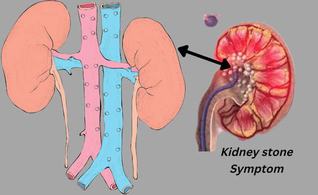 kidney Stone photo