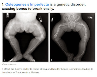 the text '1. Osteogenesis Imperfecta is a genetic disorder, causing bones to break easily.' followed by 2 x-rays of the legs of a person with type III OI.