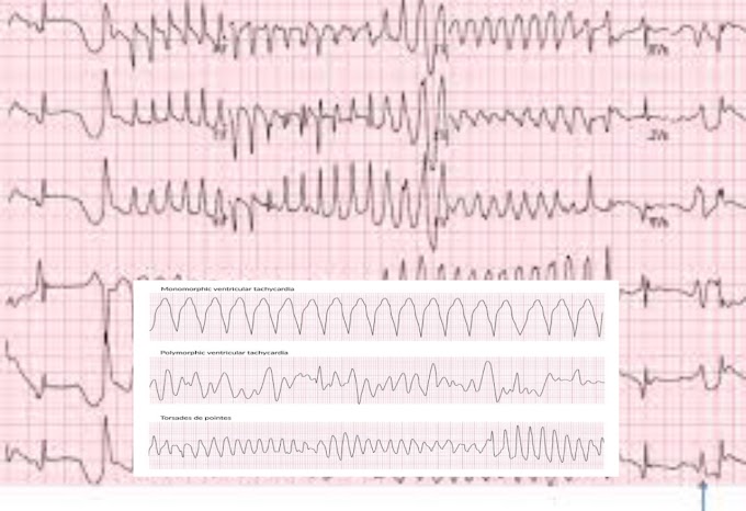 polymorphic ventricular tachycardia 2023