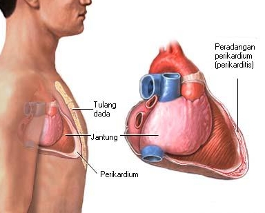 Sakit Radang Lapisan Jantung Perikarditis