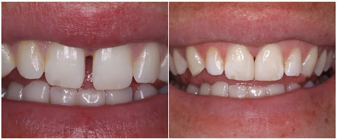 Tratamiento para solucionar un diastema (Odontología)