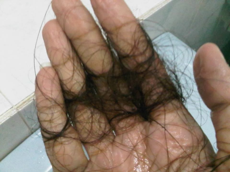 7 Punca rambut gugur sampai botak  Mauceriasokmo