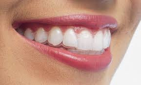 Phân tích niềng răng trong suốt có tốt không từ nha sĩ-1
