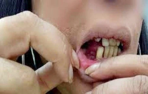 Violência doméstica: marido violento quebra dois dentes da mulher com socos e foge