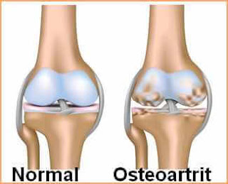 Osteoartrit tedavi
