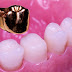 Răng sâu có cần bọc răng sứ không?