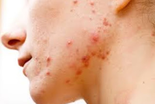 Acne stone is also known as cystic acne, acne stone classified as severe acne. Characteristic of acne stone is a large bulge, spread across the face, and accompanied by great inflammation