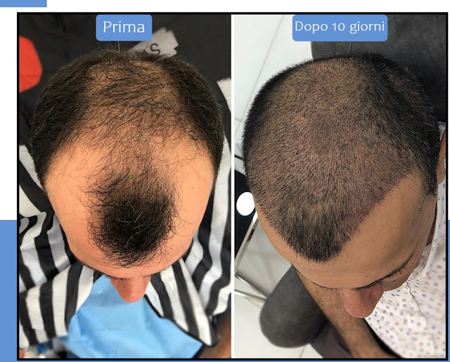 Uomo di 34 anni, dopo trapianto di capelli con metodo FUE Zaffiro, prima e dopo circa 10 giorni dal trapianto, dopo aver rimosso le croste