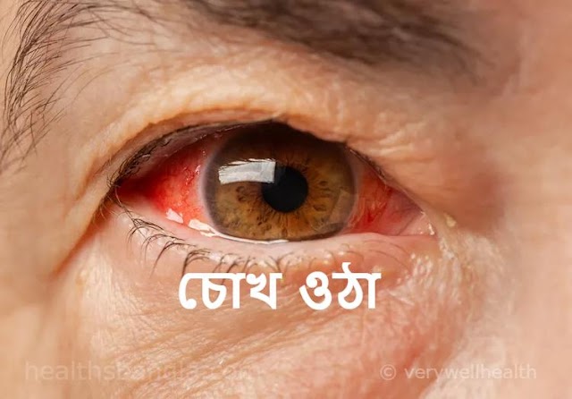  চোখ উঠা:  চোখ উঠার কারণ লক্ষণ ও প্রতিকার - Conjunctivitis (Pinkeye)