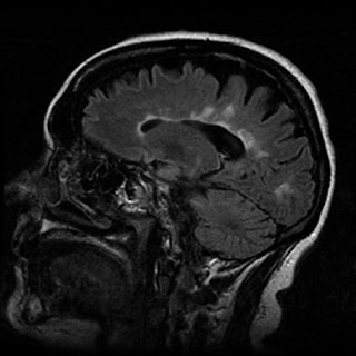 multiple sclerosis brain