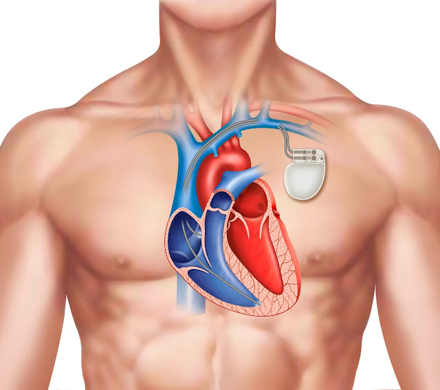 Cardiac Pacemaker Market