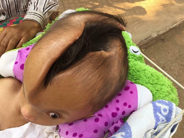 Boy with massive crack across his skull keeps growing