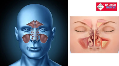 What is Acute sinusitis?