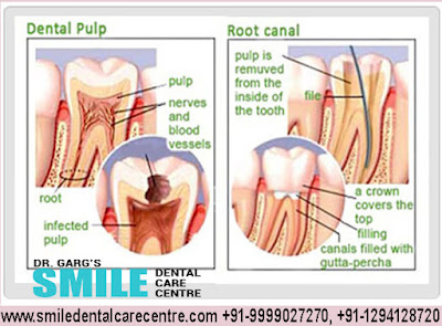 Painless Root Canal Treatment