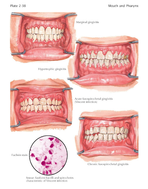 Gingivitis